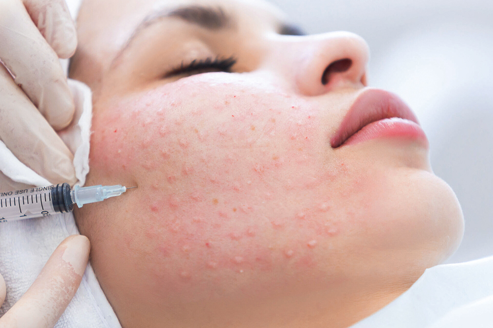 Био, Мезо и Коллагенотерапия